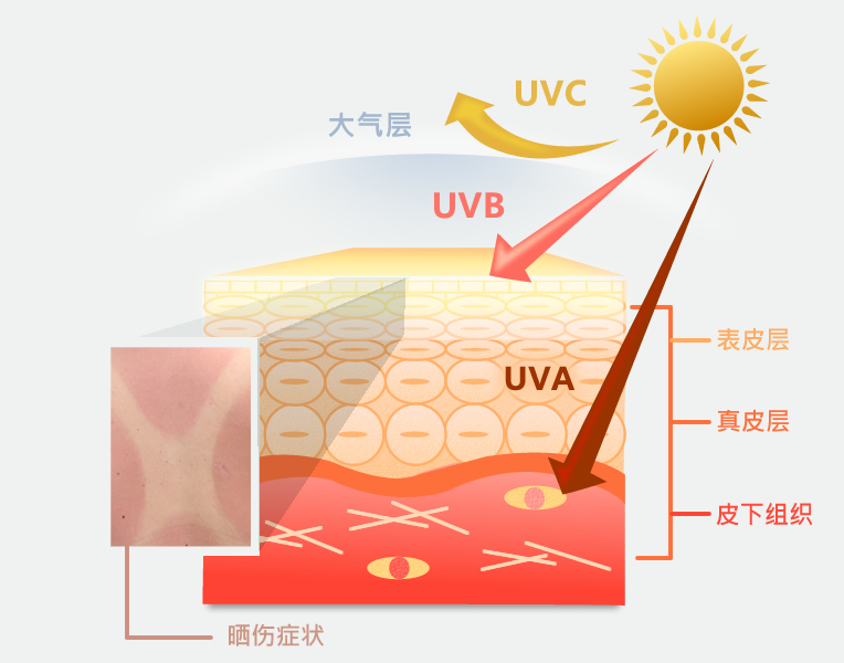 紫外线是皮肤晒伤主因